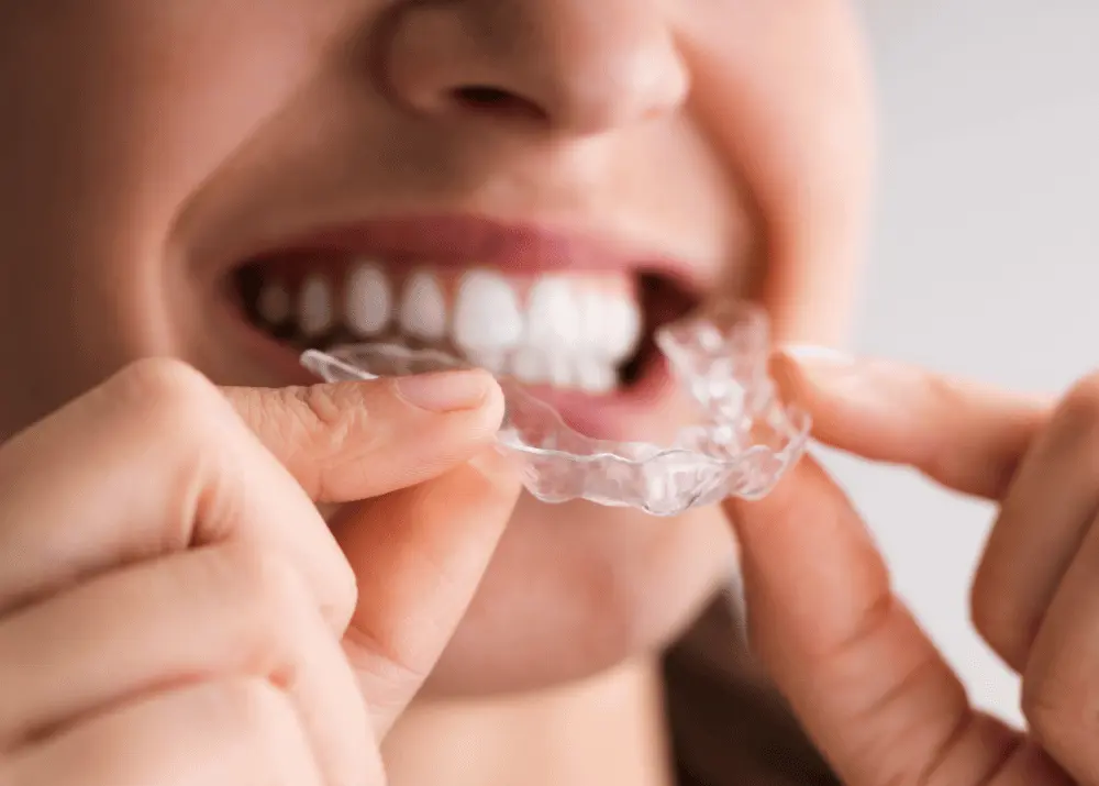 Aligners and Invisalign