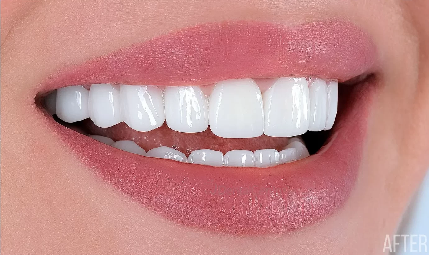 Cosmetic Veneers