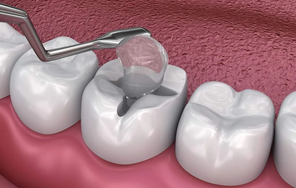 Fillings and Sealants